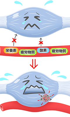 痛みを引き起こしている筋肉